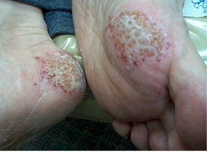 Psoriasis of the foot